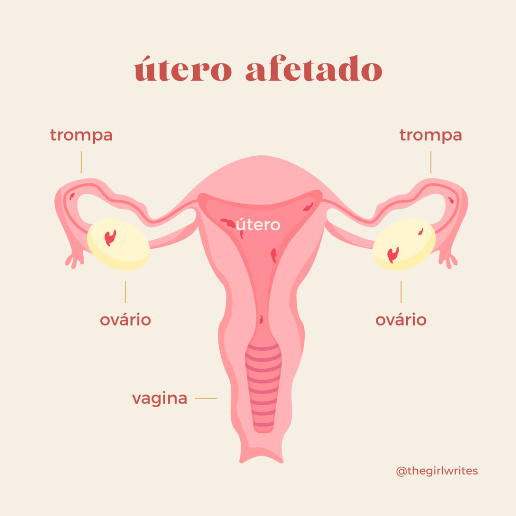 útero afetado por endometriose